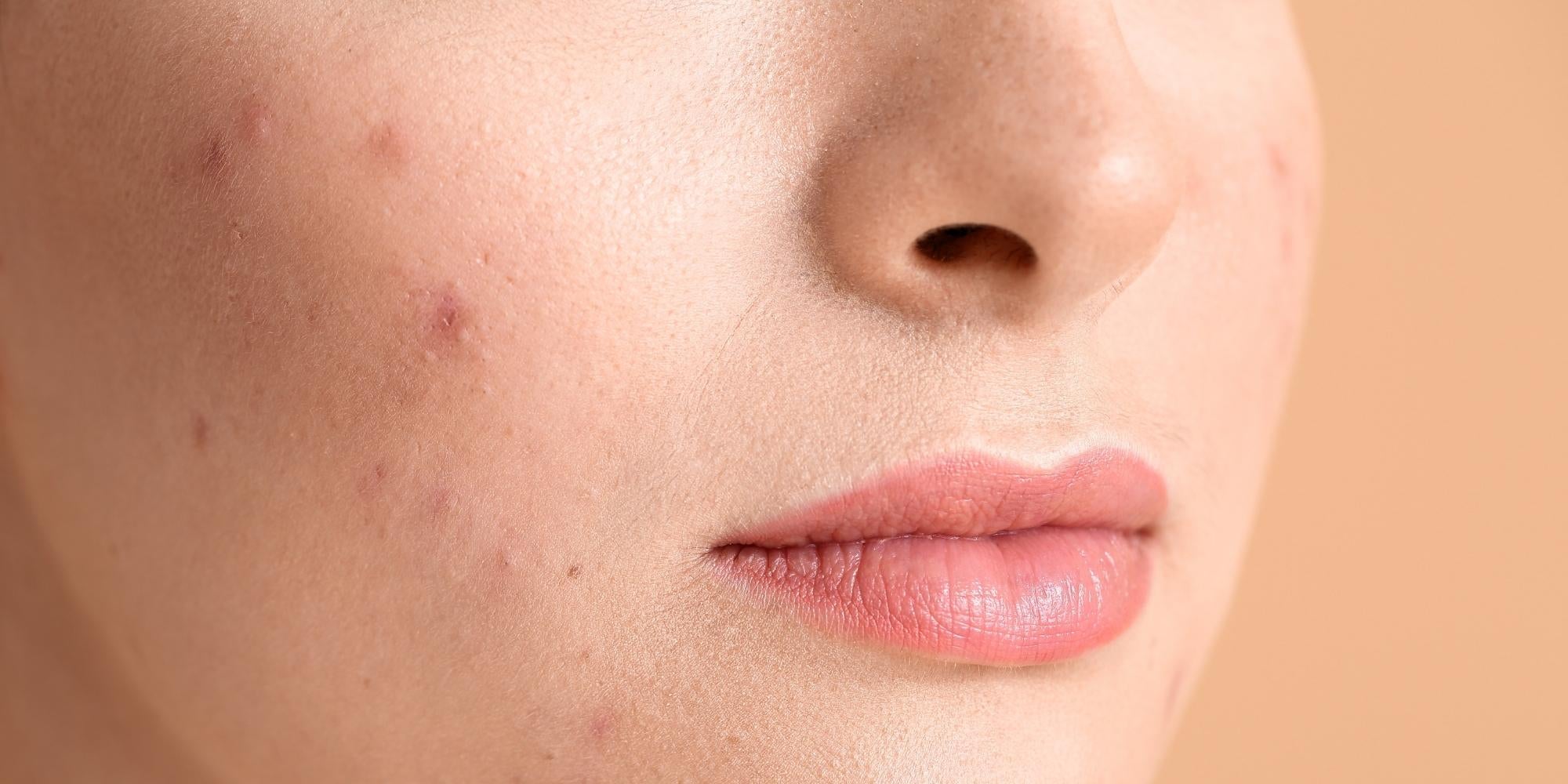 Best Serums for Oily Skin: A Guide to a Clearer Complexion