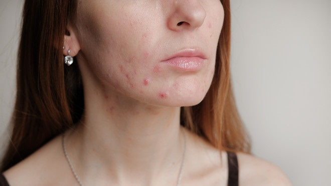 Acne: ingredients that work