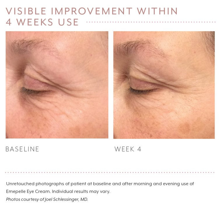 anti ageing eye cream before and after photo
