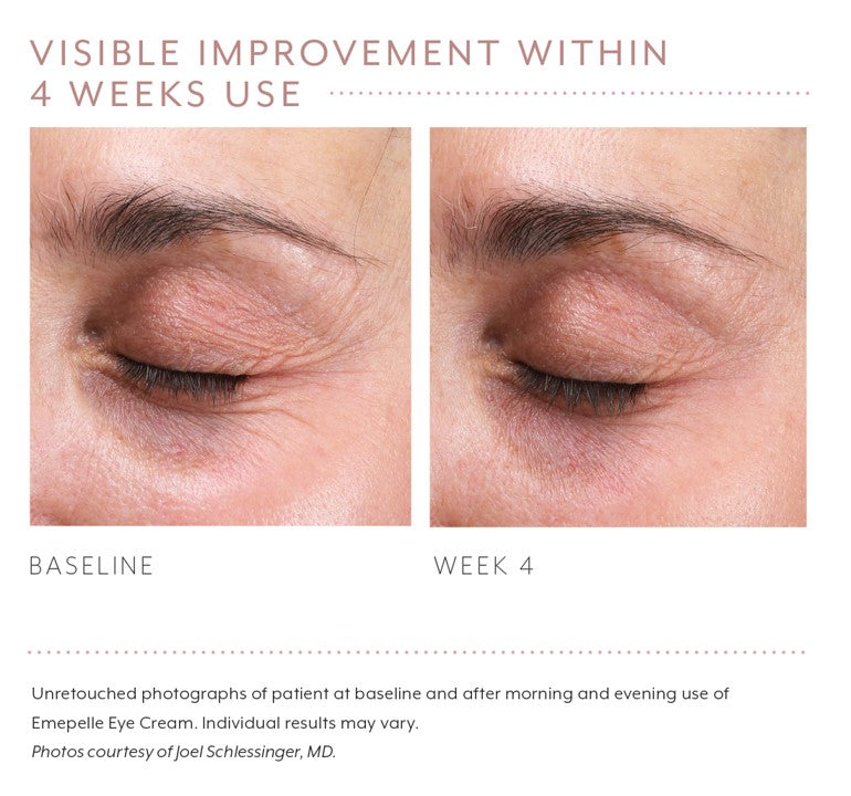 before and after photo eye cream