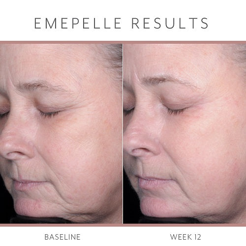 Emepelle Serum