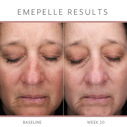 Emepelle Serum