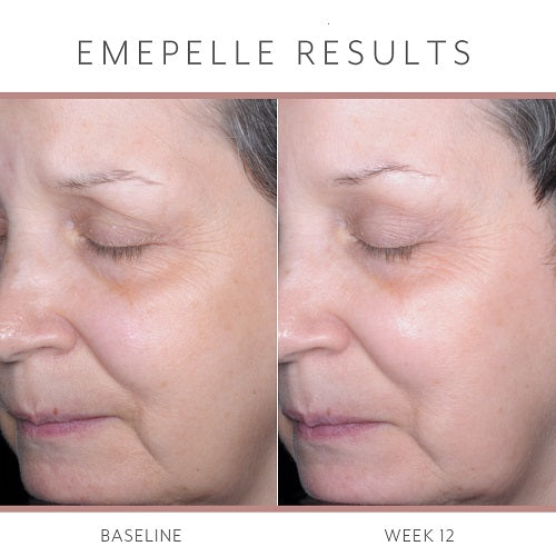 Emepelle Serum