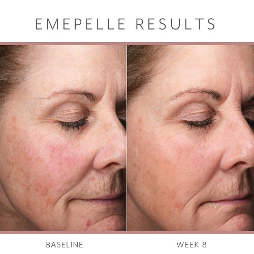 Emepelle Serum